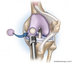 OSTEOCHONDRAL-ALLOGRAFT-preview