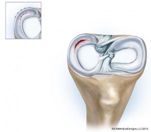 damaged-meniscus-preview
