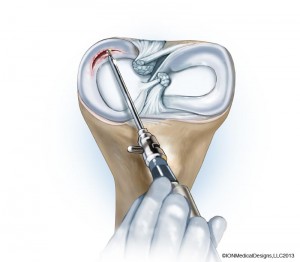 meniscus-debrided-preview