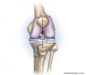 osteotomy-preview