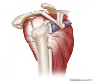 shoulder-lateral-preview