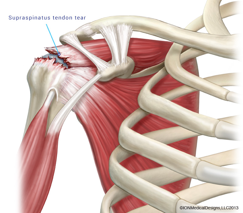 Rotator Cuff Tear - Joint Preservation Center